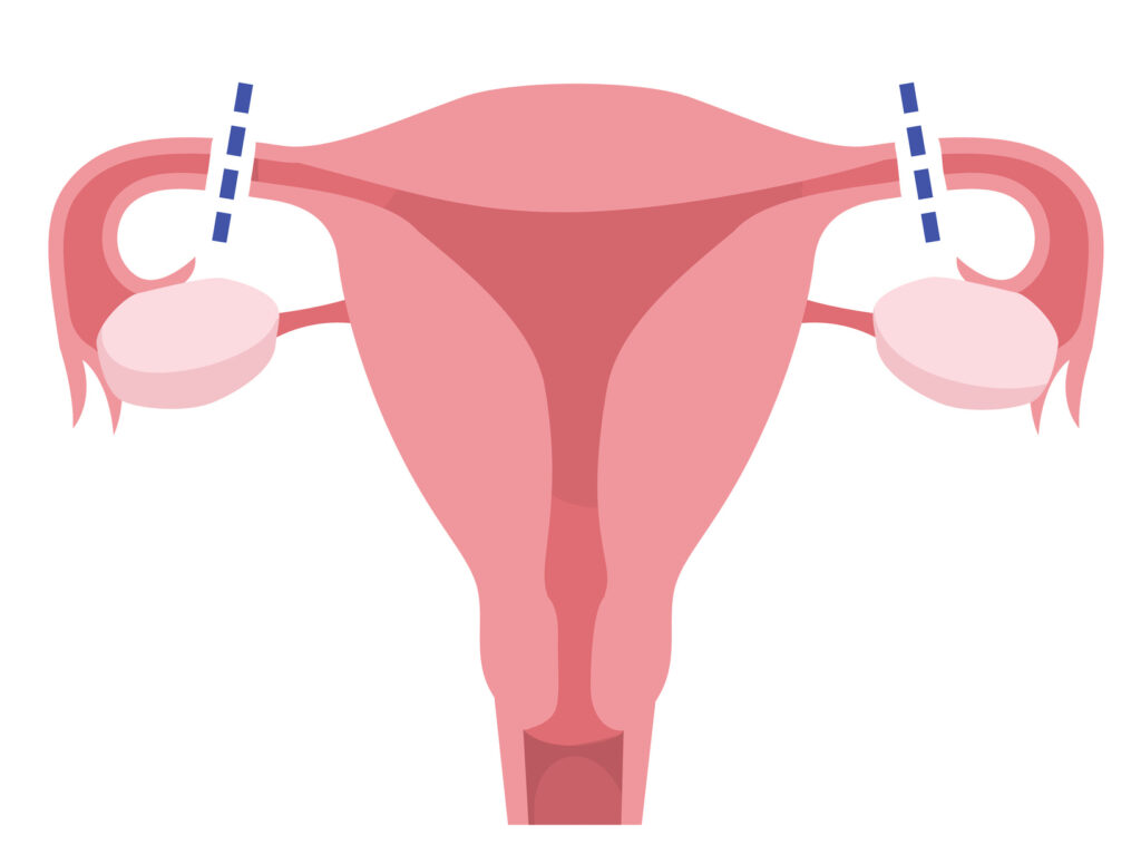 illustration of a uterus with lines across the fallopian tubes to indicate tubal ligation.