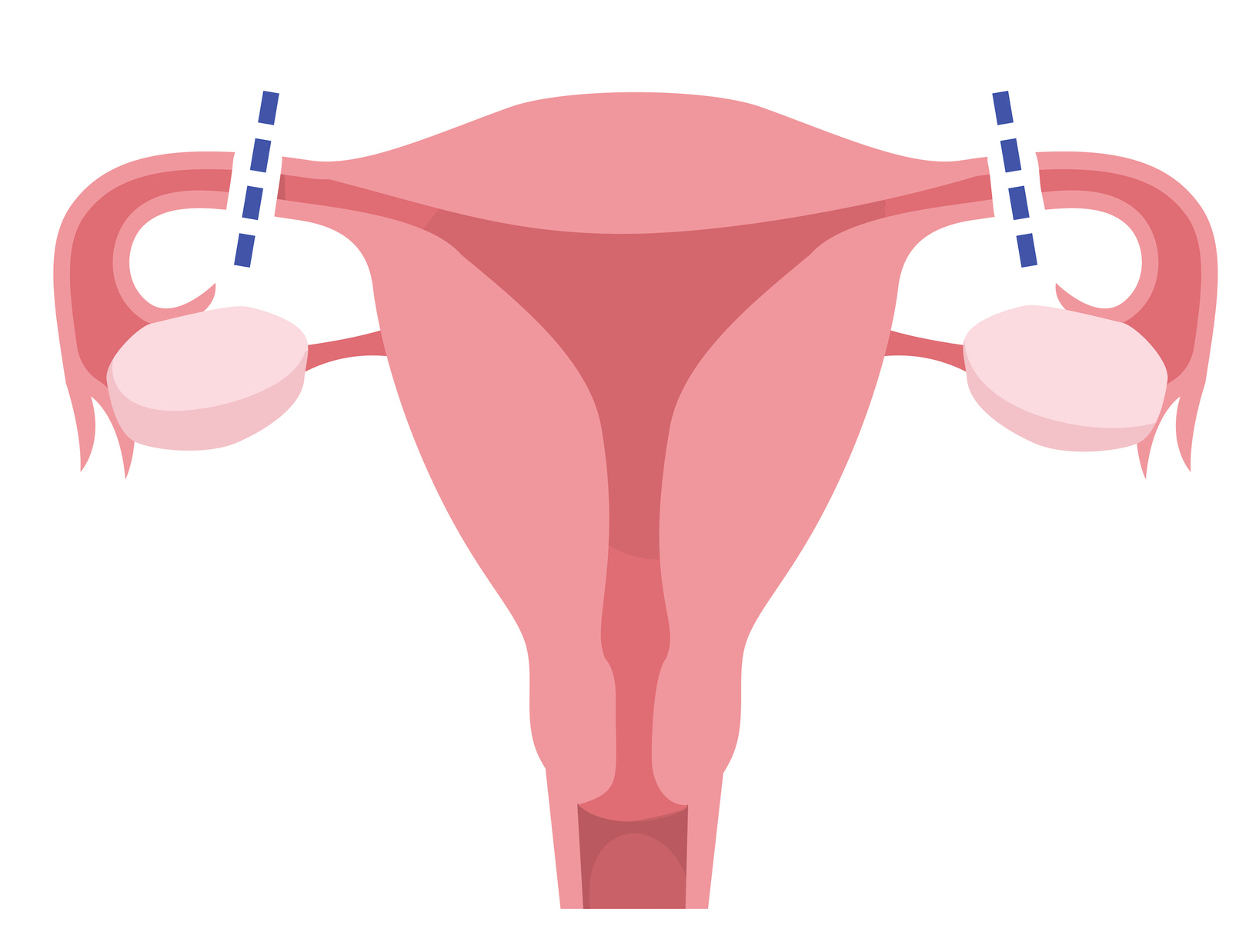 A uterus showing fallopian tubes which are cut and tied.