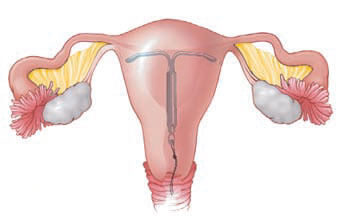 An illustration of a uterus with an IUD resting in the center