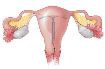 Una ilustración de un útero con un DIU descansando en el centro