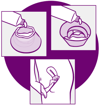 Showing the steps of how to fill a cervical cap with spermicide on both sides then inserting it into the vagina to cover the cervix.