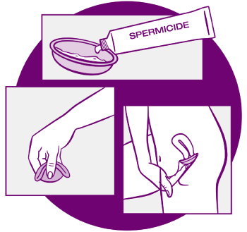 A group of three instructional photos of how to use a diaphragm. The 1st photo is squeezing a tube of spermicide into the diaphragm. The 2nd photo is pinching the diaphragm between your thumb and fingers. The 3rd photo is inserting the diaphragm into the vagina. 